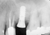 Figure 11  Insertion of a 4.8-mm implant, which fit snugly and increased the surface area for future osseointegration.