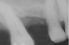 Figure 12  Initial radiograph at site No. 3.
