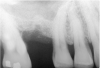 Figure 13  Despite initial perforation into the sinus with the 2.1-mm twist drill, the drilling sequence was continued after the drill depth was adjusted to be 1 mm short of the subantral floor. The radiograph demonstrates that after the subantral floor was up-fractured and bone was added via the osteotomy, the initial puff of bone was contained. Therefore, the procedure could continue.