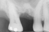 Figure 14  Additional bone was added via the osteotomy.