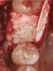 Fig 1. A significant loss of bone necessitated covering the BPCS with a dense PTFE barrier.