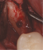 Fig 5. Reentry at 7 months demonstrated full ridge width preservation and minimal residual graft material.