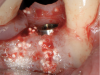 Fig 8. Eight months after grafting the extraction socket an implant was placed in a well-healed ridge. (Surgery in this case performed by Dr. Leventis.)