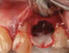 Fig 9. A semi-rigid synthetic barrier was inserted in a subperiosteal manner where a significant loss of palatal bone and thin buccal plate existed.