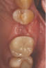 Fig 11. The 6-week healing showed preservation/reformation of the alveolar ridge width and an increase in the width of keratinized tissue to enhance future esthetics.