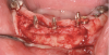 Fig 12. Deficient anterior mandibular ridge with transitional implants in place to retain a transitional fixed prosthesis, eliminating the chance of premature loading over the surgical site.