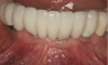 Fig 13. 3 years after prosthetic loading, the alveolar volume enabled both ideal placement and restoration of dental implants and supported healthy, thick keratinized tissue.