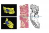 Fig 1. Representative images of 3D reconstructions of the maxillary sinus cavity of the skull show the bone volume that was grafted (blue areas) in the control (Fig 1) and stem cell therapy (Fig 2) groups in bony defects. Histological and corresponding micro CT images of bone biopsies harvested from the grafted regions of the two groups show a greater degree of mineralized bone tissue in the stem cell therapy group (Fig 2). (Images reprinted with permission from Kaigler D, Avila-Ortiz G, Travan S, et al. J Bone Miner Res. 2015;30[7]:1206-1216.)