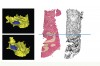 Fig 2. Representative images of 3D reconstructions of the maxillary sinus cavity of the skull show the bone volume that was grafted (blue areas) in the control (Fig 1) and stem cell therapy (Fig 2) groups in bony defects. Histological and corresponding micro CT images of bone biopsies harvested from the grafted regions of the two groups show a greater degree of mineralized bone tissue in the stem cell therapy group (Fig 2). (Images reprinted with permission from Kaigler D, Avila-Ortiz G, Travan S, et al. J Bone Miner Res. 2015;30[7]:1206-1216.)