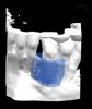 Fig 12. A 3D printed scaffold was designed using CAD software to fit a peri-osseous defect in a human patient. The scaffold consisted of a region with channels designed to support oriented PDL tissue formation and a region for the regeneration of osseous tissue. Fig 3: baseline; 
Fig 4: defect model; Fig 5 through Fig 7: internal, tilted, and side views of scaffold, respectively; Fig 8 through Fig 10: coronal, middle, and apical 
angles, respectively; Fig 11: cross-section diagram; Fig 12: labial scan image. (Images reprinted with permission from Rasperini G, Pilipchuk SP, Flanagan CL, et al. J Dent Res. 2015;94[9 suppl]:153S-157S.)