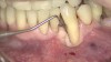 Fig 13. The scaffold was placed in the defect, where it remained for approximately 1 year. Fig 13: baseline; Fig 14: defect; Fig 15: scaffold matrix; Fig 16: scaffold placement; Fig 17: wound closure; Fig 18 through Fig 20: 2-month, 6-month, and 1-year postoperative, respectively. (Images reprinted with permission from Rasperini G, Pilipchuk SP, Flanagan CL, et al. J Dent Res. 2015;94[9 suppl]:153S-157S.)