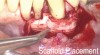 Fig 16. The scaffold was placed in the defect, where it remained for approximately 1 year. Fig 13: baseline; Fig 14: defect; Fig 15: scaffold matrix; Fig 16: scaffold placement; Fig 17: wound closure; Fig 18 through Fig 20: 2-month, 6-month, and 1-year postoperative, respectively. (Images reprinted with permission from Rasperini G, Pilipchuk SP, Flanagan CL, et al. J Dent Res. 2015;94[9 suppl]:153S-157S.)