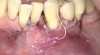 Fig 17. The scaffold was placed in the defect, where it remained for approximately 1 year. Fig 13: baseline; Fig 14: defect; Fig 15: scaffold matrix; Fig 16: scaffold placement; Fig 17: wound closure; Fig 18 through Fig 20: 2-month, 6-month, and 1-year postoperative, respectively. (Images reprinted with permission from Rasperini G, Pilipchuk SP, Flanagan CL, et al. J Dent Res. 2015;94[9 suppl]:153S-157S.)