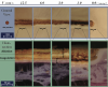 Fig 8. NBTC stain showing effect of cutting speed on collateral thermal damage using
TOP surgery cuts.