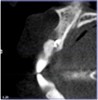 Fig 2. Preoperative CBCT confirmed absence of buccal bone.