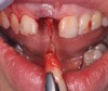 Fig 3. Atraumatic extraction of central incisor.