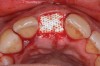 Fig 7. The d-PTFE barrier was tucked under the palatal flap (3 mm).