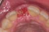 Fig 9. Wound healing was evident immediately after d-PTFE barrier removal. Red osteoid tissue was present.