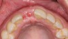 Fig 10. At 7 weeks follow-up, keratinized tissue was present.