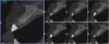 Fig 12. CBCT at 4 months postoperative showed vertical bone regeneration.