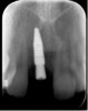 Fig 17. Interrupted 4-0 Vicryl sutures.