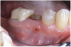 Figure 1 Fistulous tract at tooth No. 30 associated with an endodontic-periodontal abscess. When palpated, the fistulous tract may express pus. Usually, a periodontal abscess will not have a fistulous tract. Its appearance usually reflects an endodontic etiology causing the lesion. (Photograph courtesy of Dr. Mehmet Dikman.)