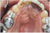 Figure 5 Palatal abscess due to non-vitality of tooth No. 8.