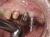 Figure 4 Following osseointegration of an implant at No. 12, recession was observed at the fixture-level impression stage of No. 13; it was decided to re-prepare the margins of the CAD/CAM custom abutment of implant No. 12. Retraction cord was placed prior to preparation to avoid tissue injury and improve visibility of both tooth No. 11 and the implant custom abutment margin. As expected, recession was greater along the distal side of abutment No. 12, adjacent to the healed extraction/newer implant site.