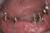 Figure 11 Recession evident around first-stage abutments following adjacent extractions and second-stage implant placement.