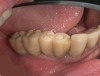Figure 15 Fixed screw-retained provisional prosthesis.