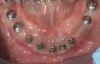 Figure 16 First-phase implants loaded with conical abutments and, in some cases, their angulated counterparts.