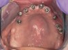 Figure 17 First-phase implants loaded with conical abutments and, in some cases, their angulated counterparts.