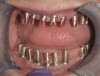 Figure 18 Custom abutments inserted.