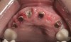 Figure 21 Endodontically treated tooth No. 8.