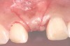 Fig 2. Bilateral vertical releasing incisions on the buccal aspect that extend obliquely, slanting away from the ends of the horizontal incision.