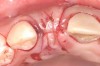 Fig 8. Submerged implant protocol, occlusal view. A horizontal releasing incision was sutured to attain primary closure. Note that there are no sutures through the thin retained papillary segments.