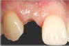 Fig 10. Case 2: Missing tooth No. 7 was extracted 3 months before implant placement.