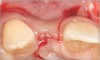 Fig 11. A horizontal releasing incision across the edentate ridge; it terminates 1 mm from the adjacent teeth.