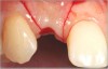 Fig 12. Vertical papillae-sparing incisions, buccal view.