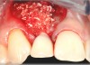 Fig 15. A temporary abutment and crown were inserted. A bone graft was then placed on the buccal aspect to augment the thin buccal bony plate.