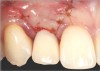 Fig 17. Vertical and horizontal incisions were sutured to attain primary closure.