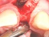 Fig 20. Papillae-sparing incisions were developed both horizontally and vertically. The pedicle flap was elevated, exposing a thin ridge.