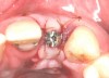 Fig 23. The healing abutment in place. Horizontal and vertical incisions were sutured.