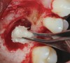 Fig 5. Bone grafting material combined with PRF fragments to fill a medium-sized sinus.