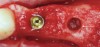 Fig 15. Use of PRF for a crestal sinus augmentation procedure. To protect the Schneiderian membrane, PRF is passed through the osteotomy site (arrow) prior to bone grafting material and implant placement.