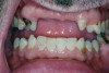 Fig 2. Caries-related tooth loss, dental caries, and abundant dental plaque present in a patient with no salivary flow in 5 minutes.