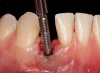 Fig 38. A reverse-torque screw was placed into the implant.