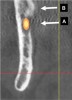 Fig 1. Mandibular foramen and lingula: cross-sectional view. A: The mandibular nerve enters the ramus at the mandibular foramen. B: The lingula is a ridge of bone superior to the mandibular foramen and provides attachment for the sphenomandibular ligament.