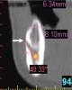 Fig 4. Mental foramen: cross-sectional view. Three branches of the mental nerve emerge from the foramen. The buccal radiolucency (mental foramen) is very distinct and provides a useful landmark when assessing cross-sections of a CBCT scan (arrow).