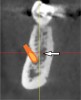 Fig 7. Marrow space: cross-sectional view. This is a hollow space within the cancellous bone (arrow).